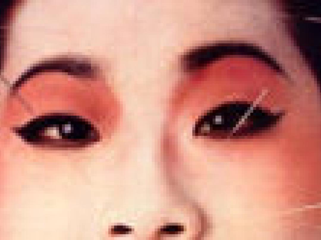 China wil ISO-normen voor acupunctuur