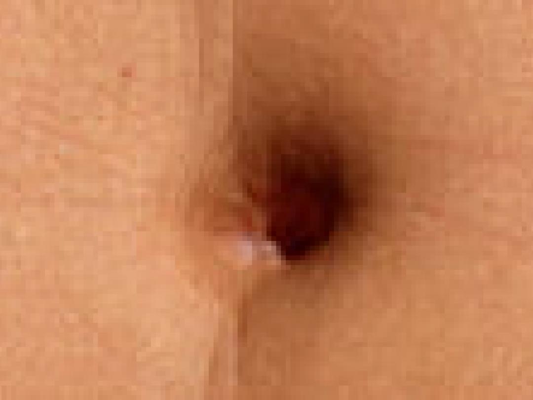 Maagverkleining bij tieners heeft direct effect