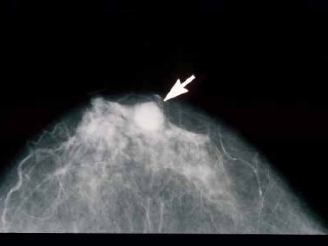 Borstkankerscreening in VS blijft onveranderd