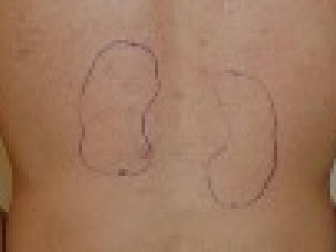 Niertransplantaat van kankerpatiënt