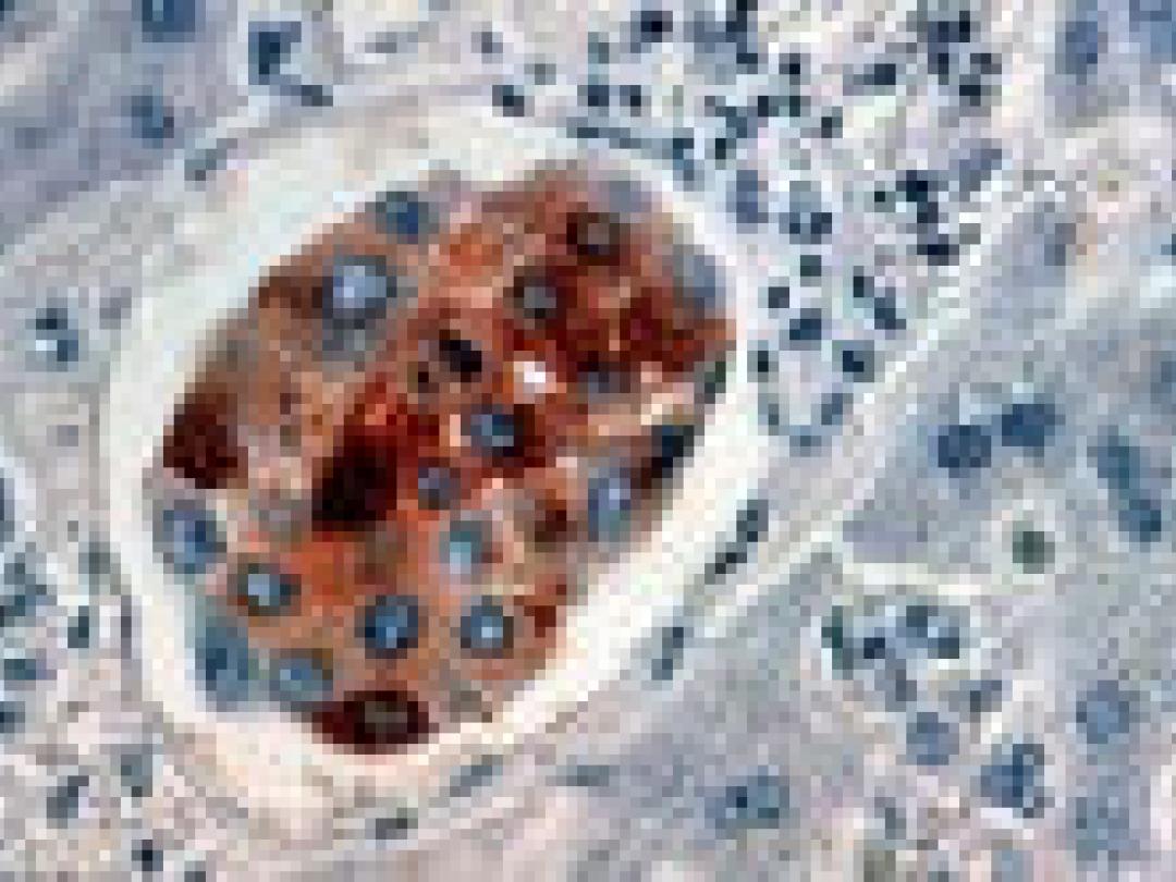 Levensverwachting na borstkankerscreening