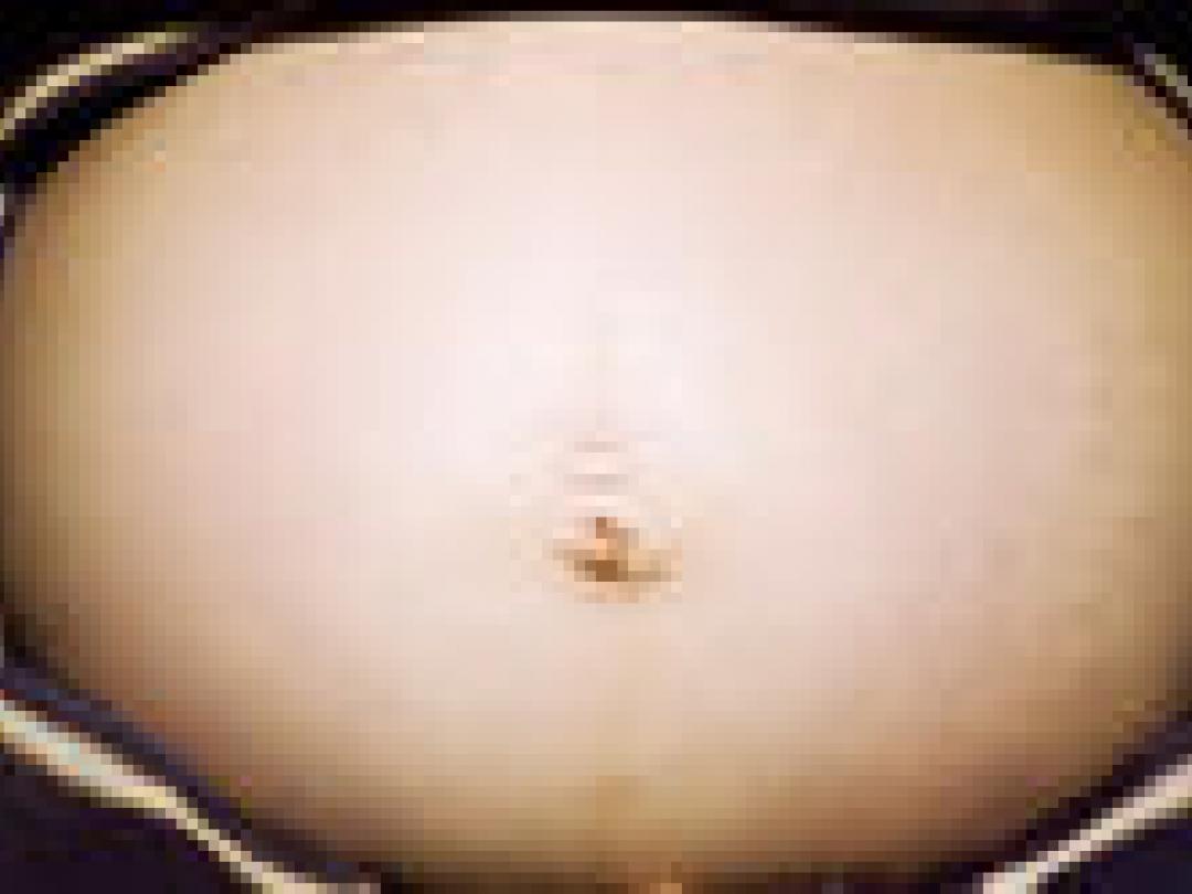 Geen relatie HPV-vaccinatie en miskraam