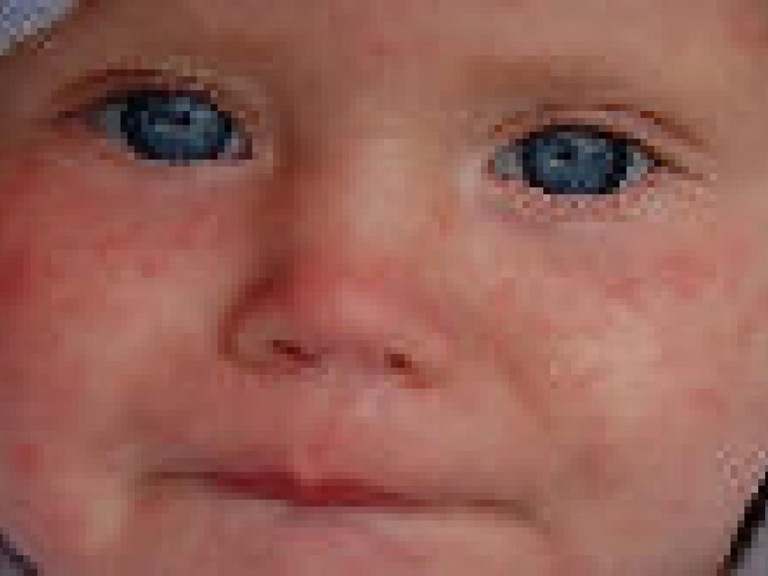 Pasgeborenen onvoldoende beschermd tegen mazelen