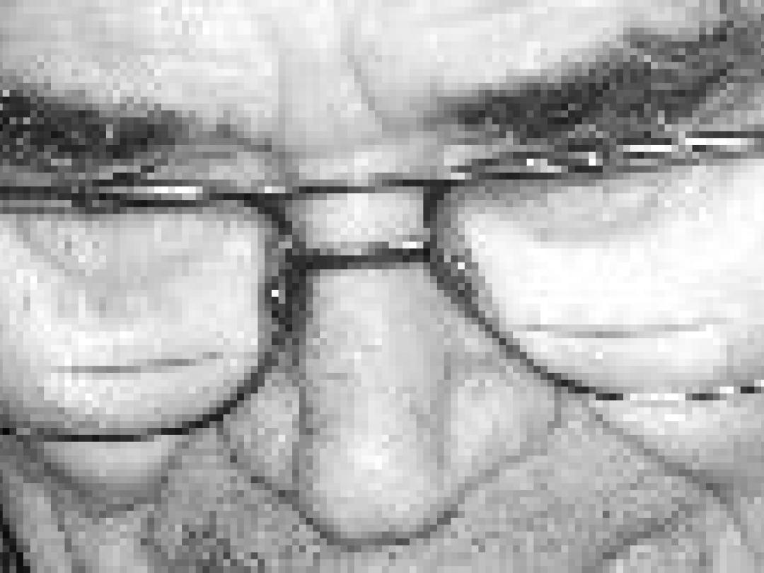 Vervang bij wandelen de bi- en multifocale bril