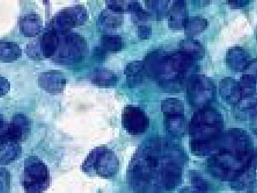 Gemcitabine niet beter dan fluorouracil na operatie alvleesklierkanker