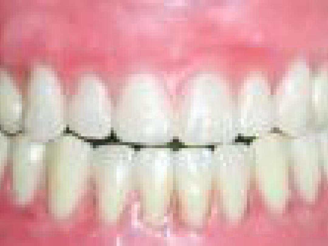 Toezicht op implementeren richtlijn mondzorg heeft nauwelijks effect