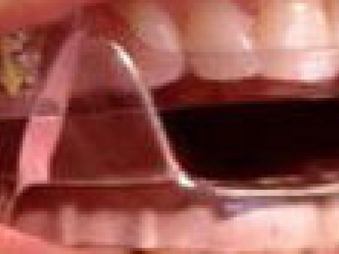 Beugel toch effectief bij slaapapneu