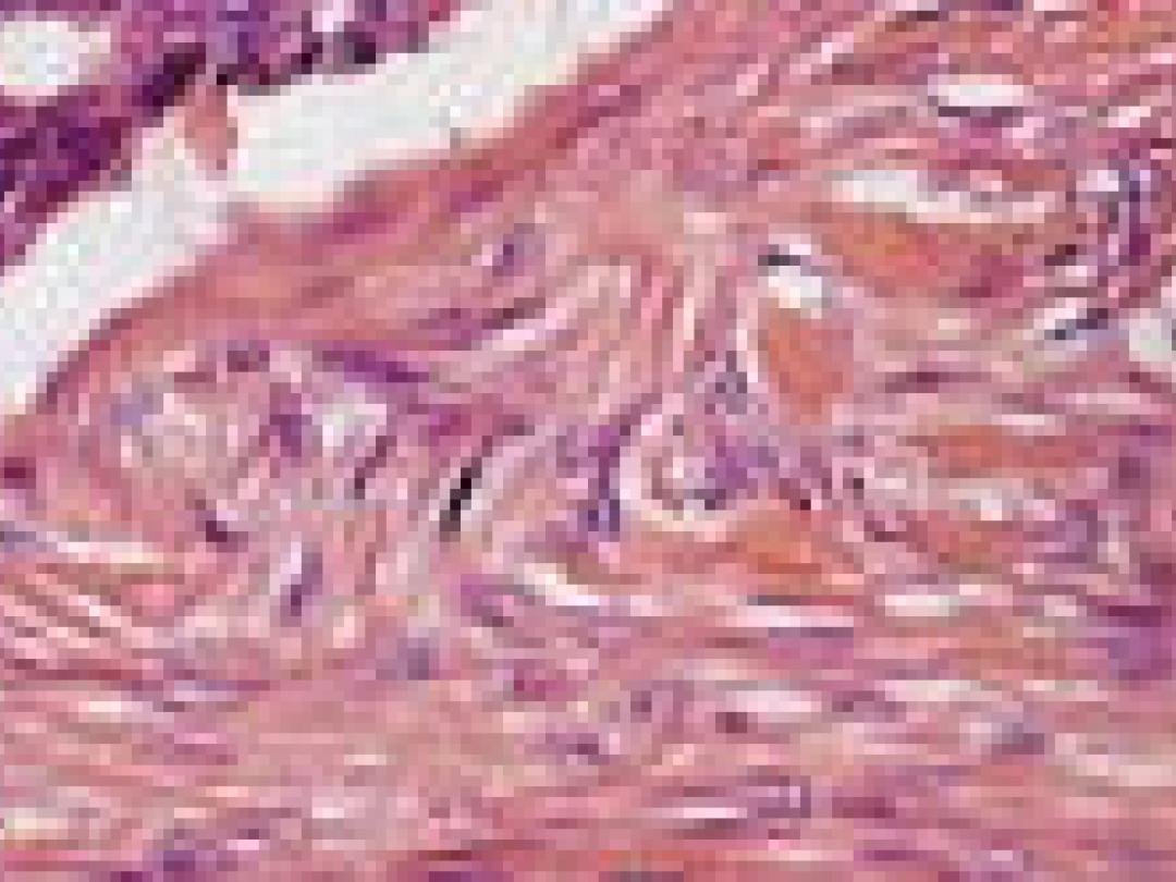 Patiënten prefereren micrografische chirurgie basalioom