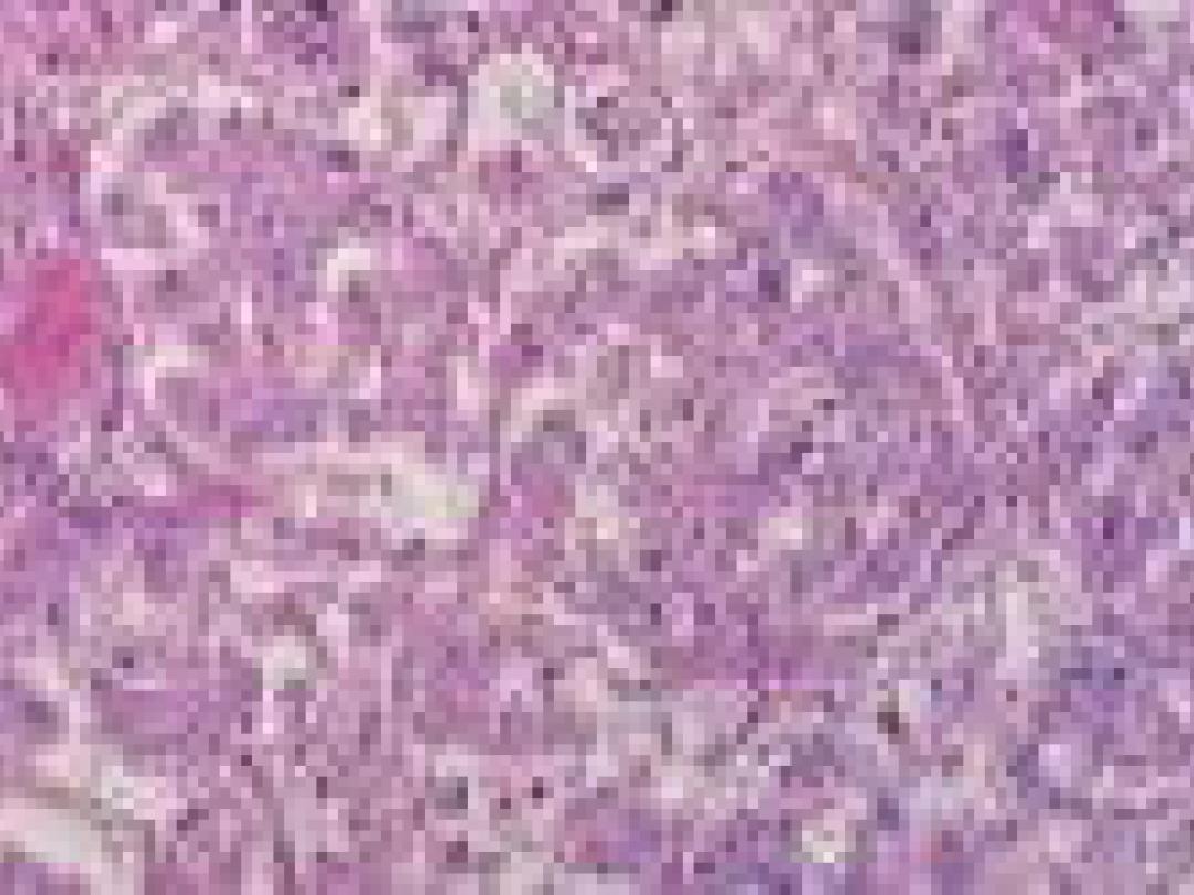 Endo-echografie verbetert stagering longkanker