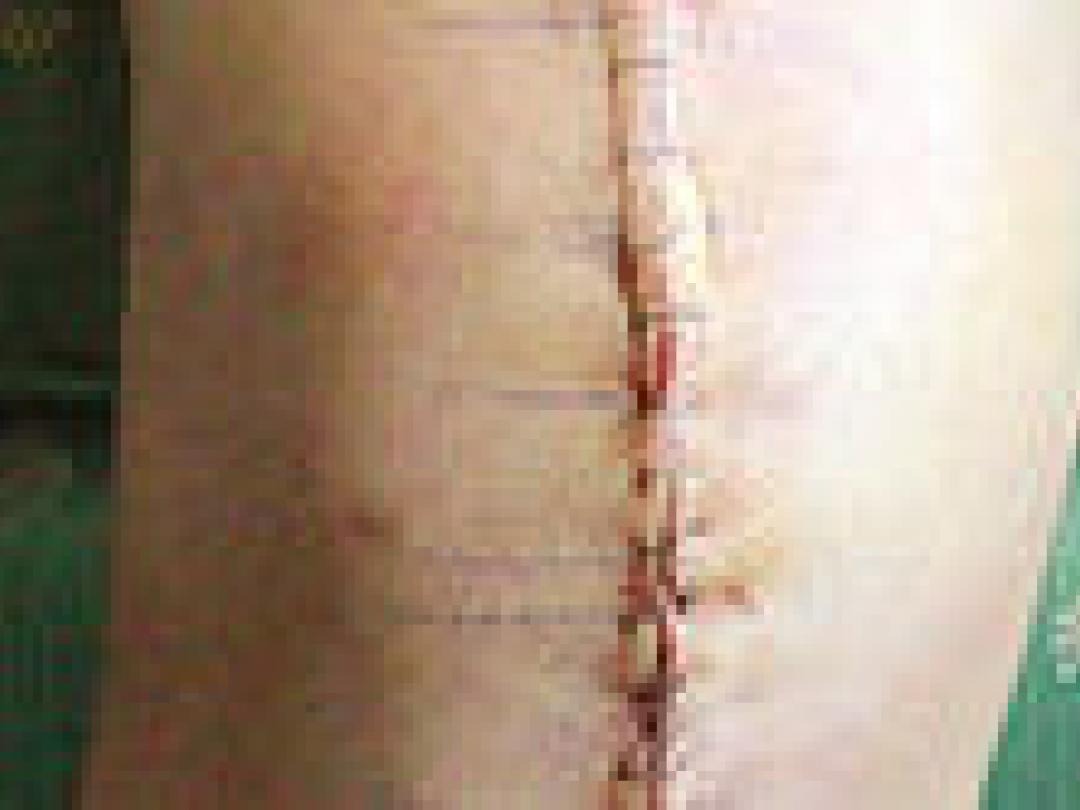 Vooral motivatie voorspelt terugkeer naar werk na knieoperatie