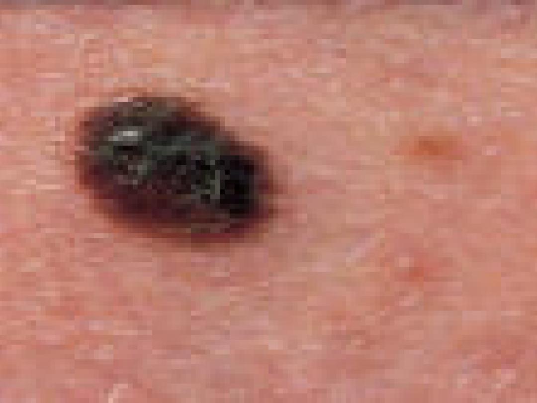 Volgen van hoogrisicopatiënten op melanomen effectief