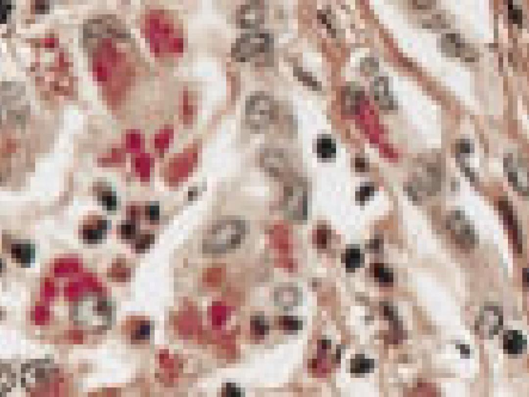 Peginterferon werkt tegen hepatitis D-virus