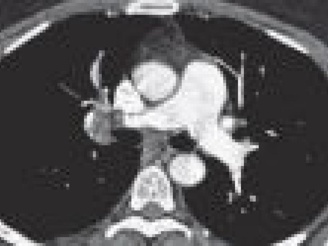 CT-angiografie sluit ook bij vrouwen coronairlijden betrouwbaar uit