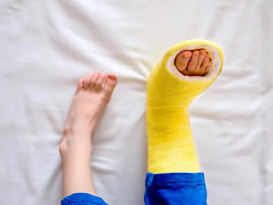 Een paar voeten waarvan de rechter voet in het gips zit.