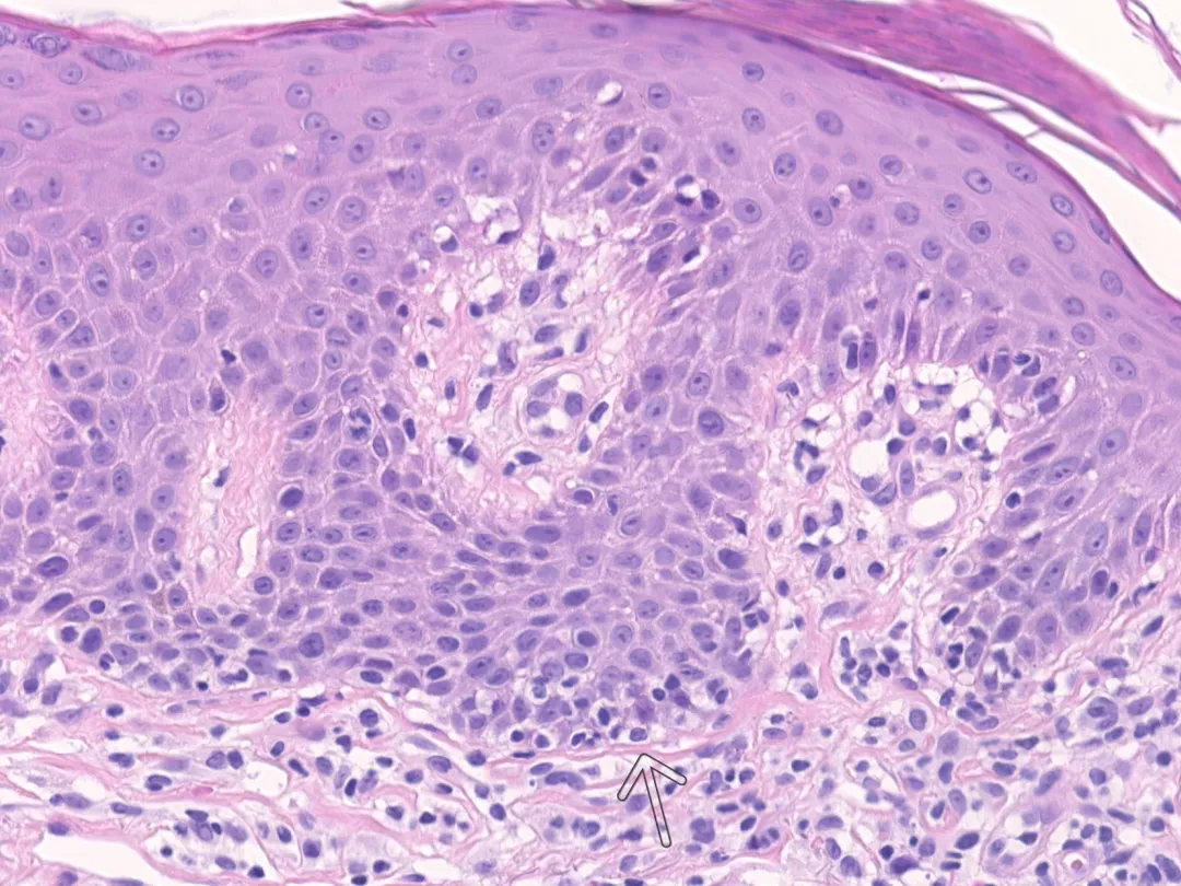 Microscopisch beeld van een huidbiopt.