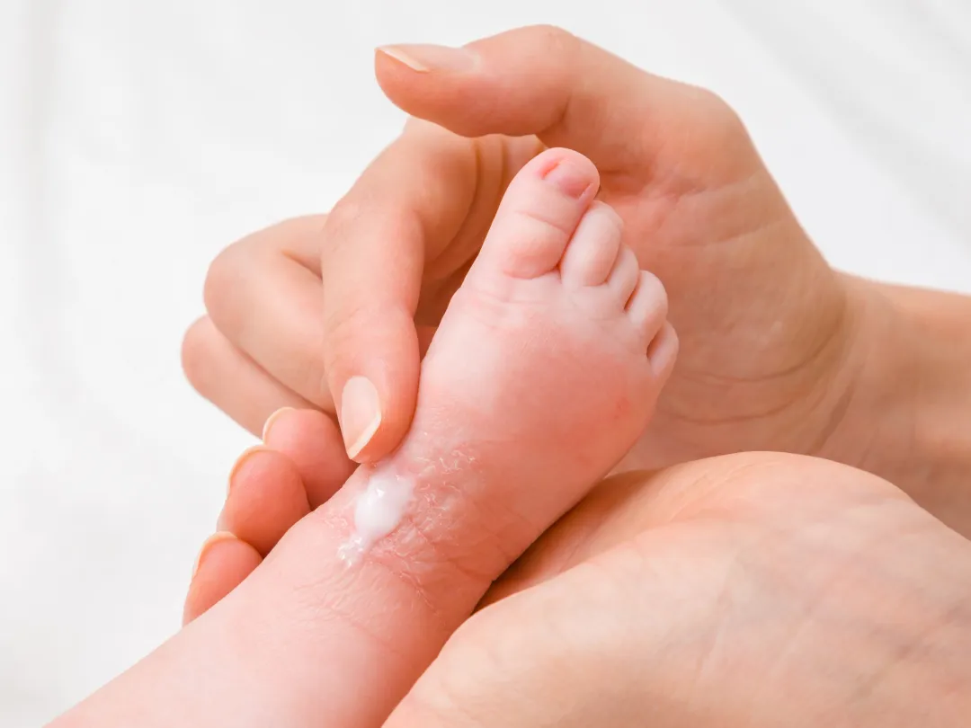 Een hand smeert zalf over de kleine voet van een kind.