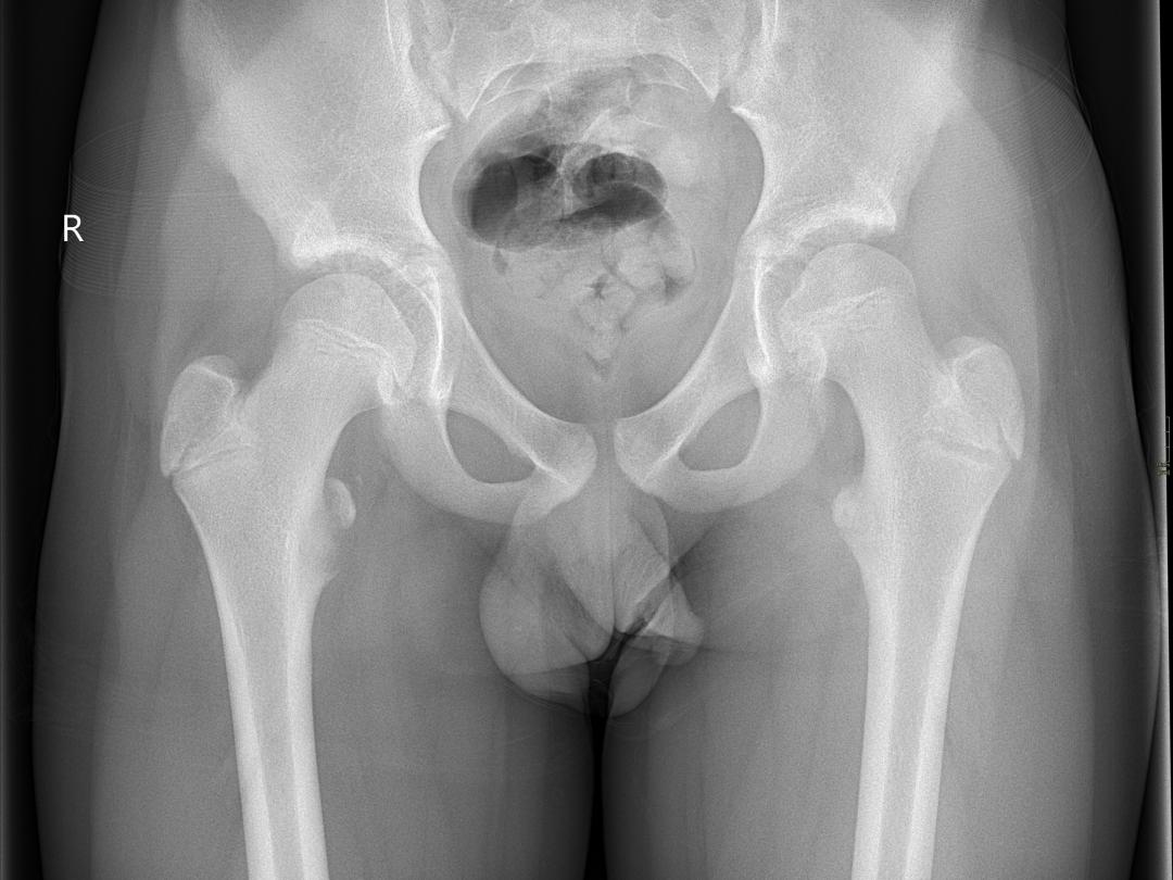 Röntgenfoto van de heupgewrichten.