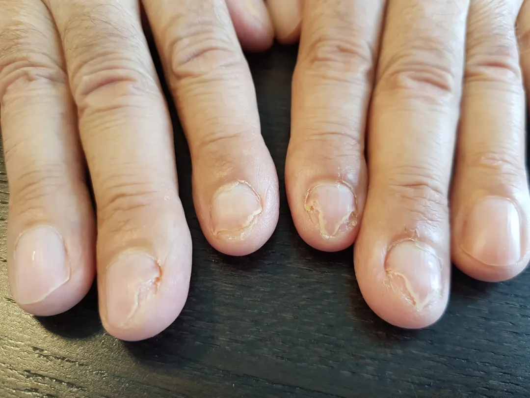Brokkelige vingernagels.