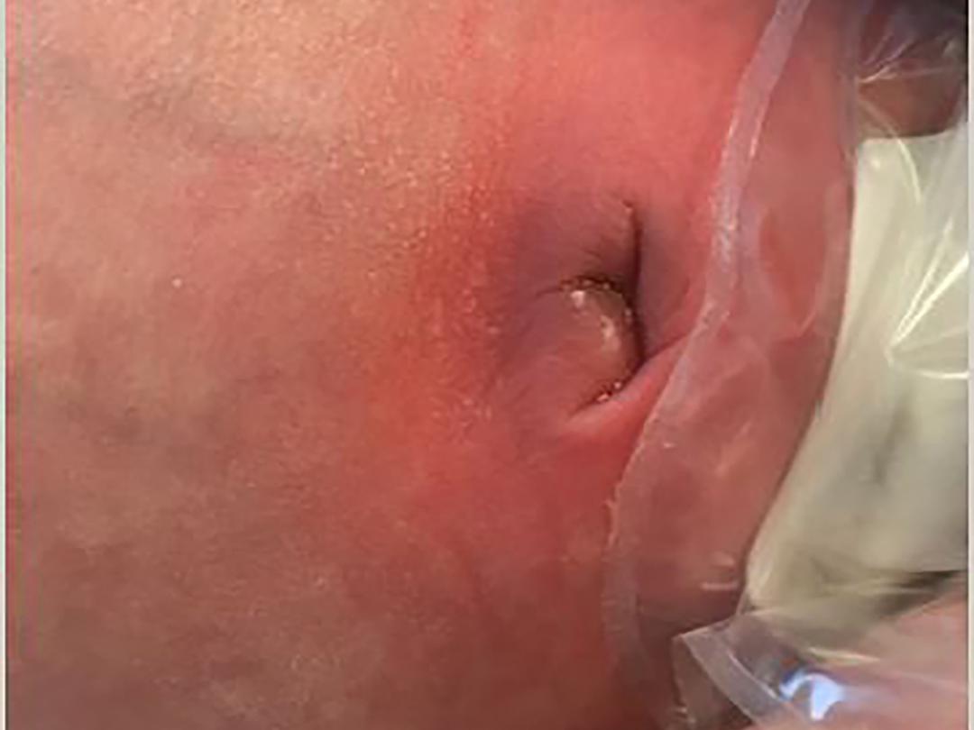 Baby met ontstoken navel