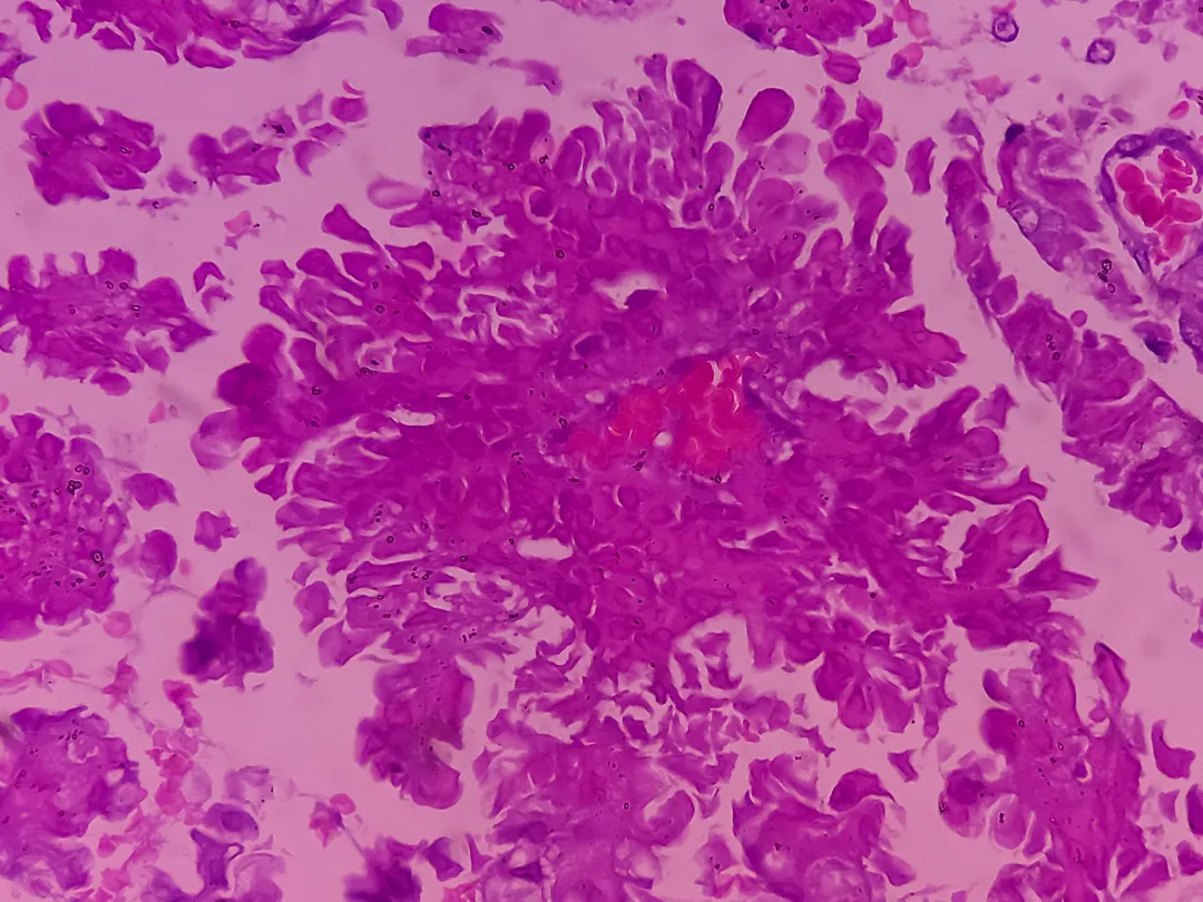 hersencarcinoom