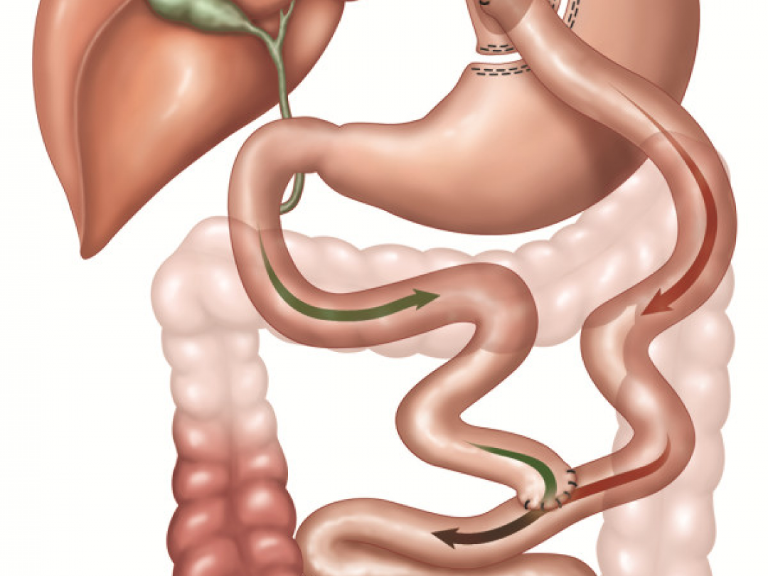 Illustratie ter verduidelijking van bariatrische chirurgie.