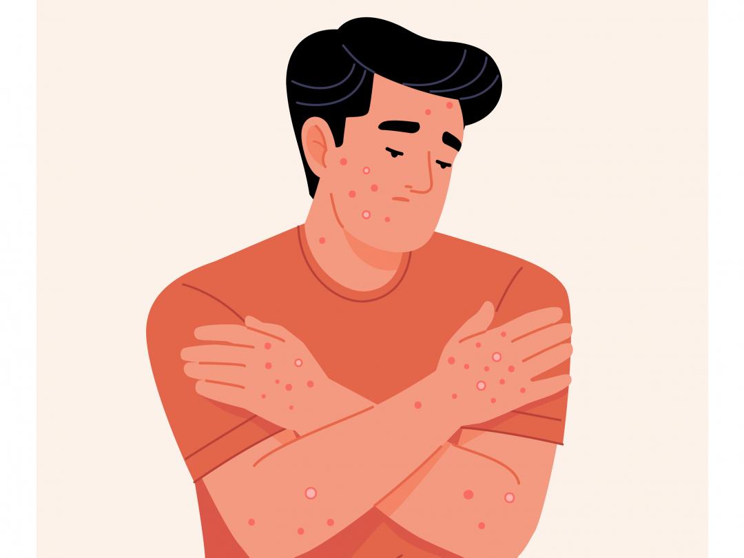 Illustratie van een somber persoon met de armen kruislings over elkaar. Op de armen en het gezicht zitten ronde vlekken.