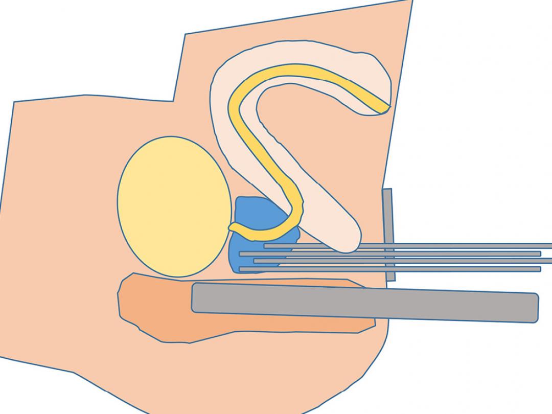 Schematische weergave van de plaatsing van de brachytherapie-katheters.