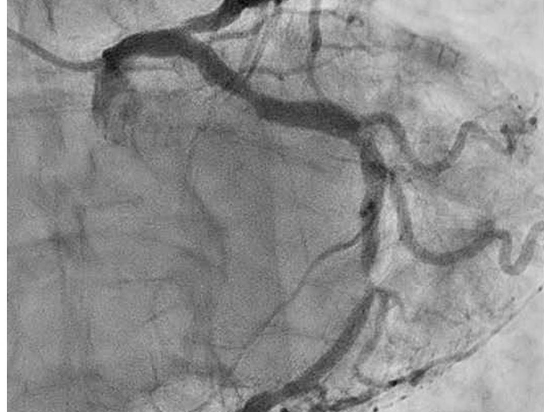 Angiogram van de A. coronaria sinistra.