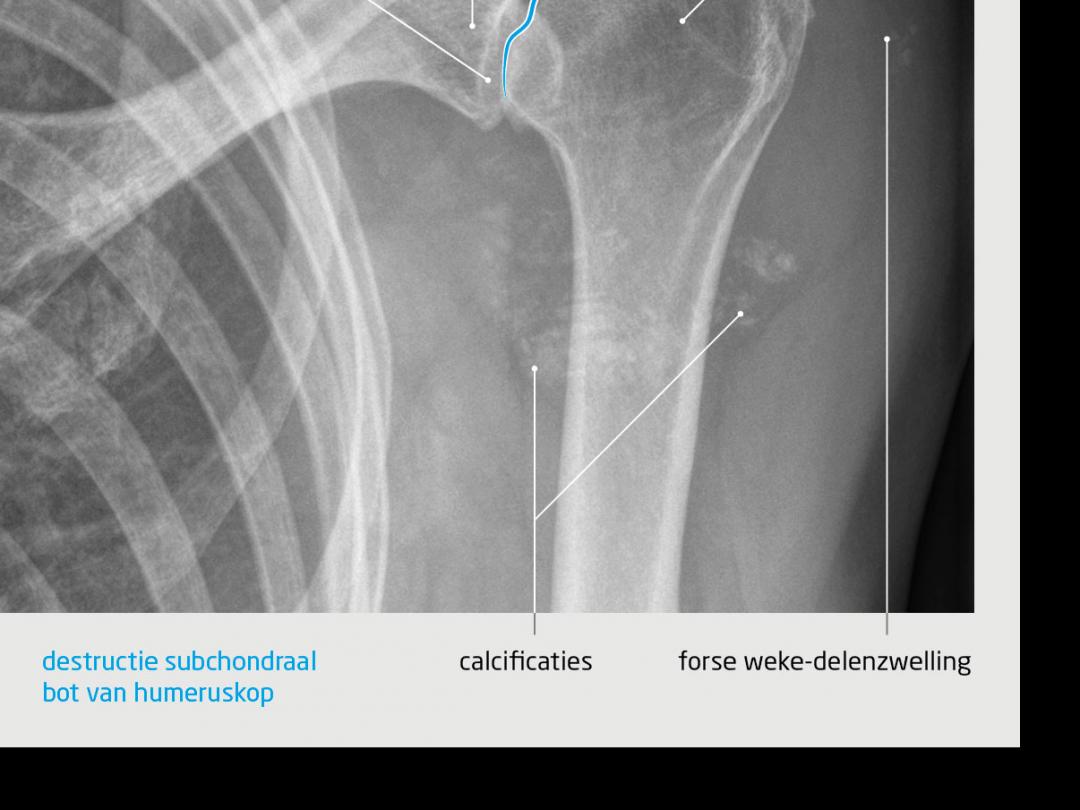 Röntgenfoto van de linker schouder