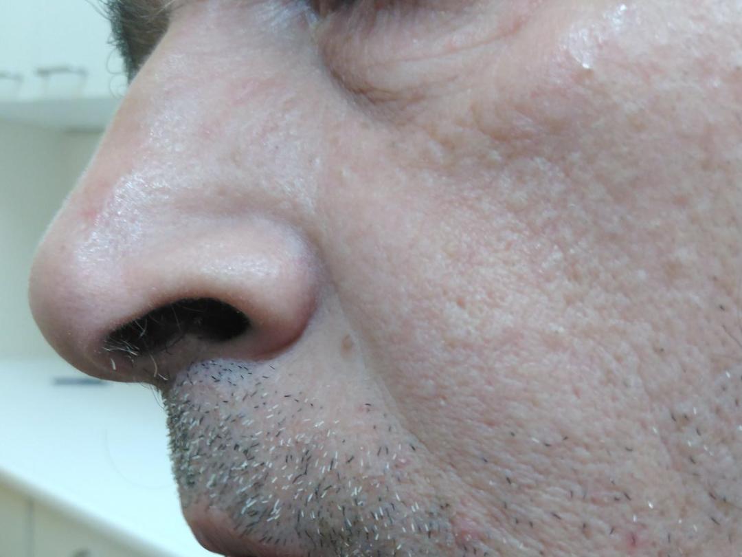 Gezicht met uitslag op de huid