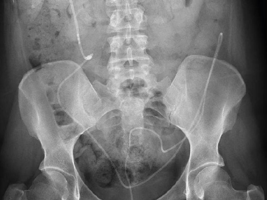 Röntgenfoto bekkengebied