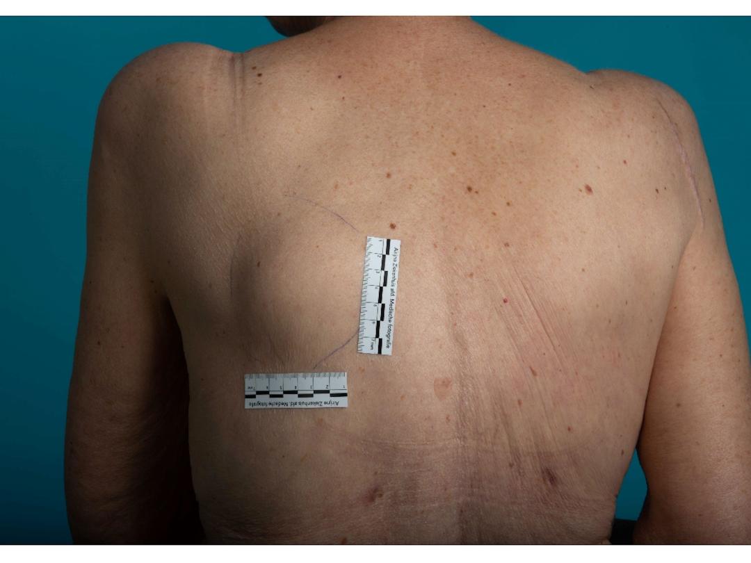 Vrouw met zwelling op haar rug