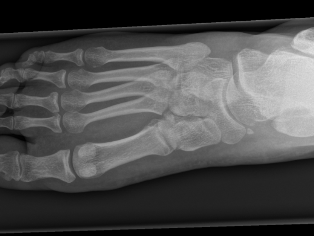 Röntgen van voet