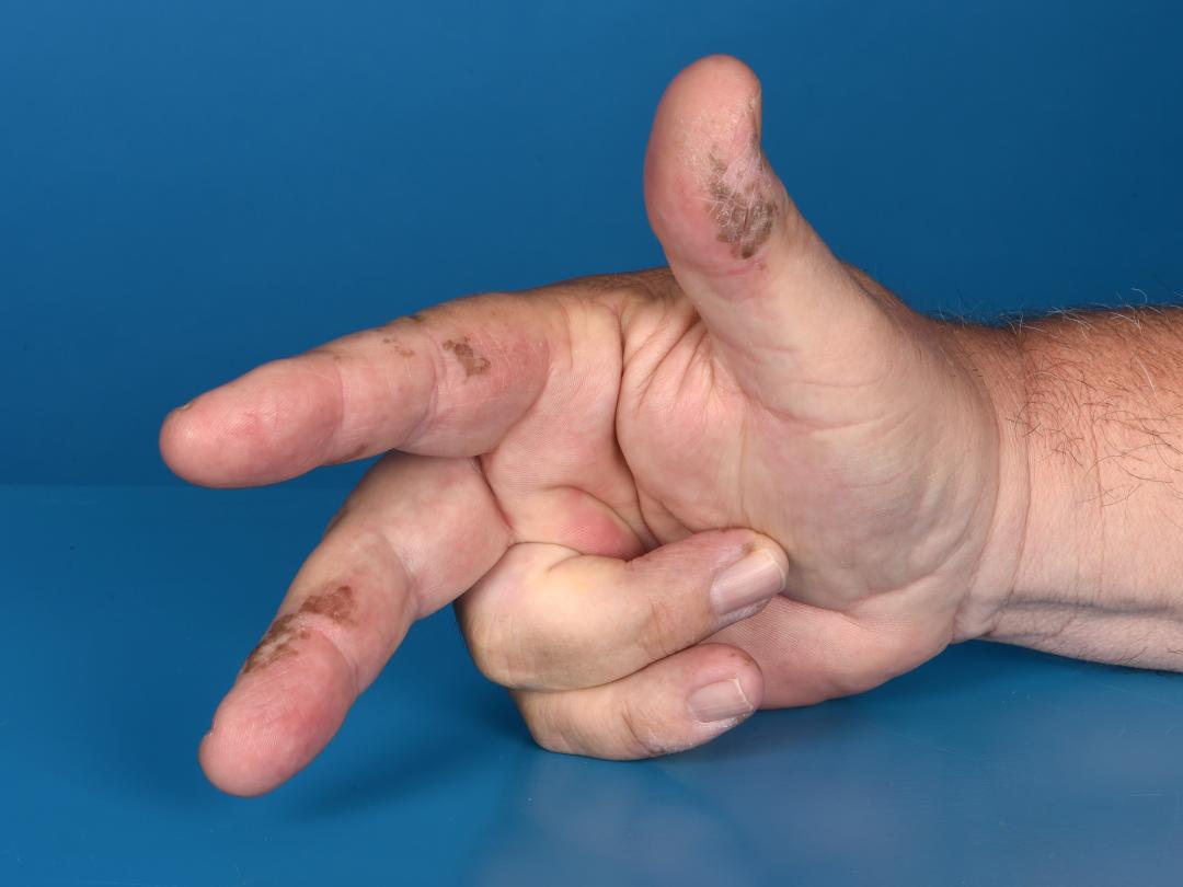 Hand met bruine vlekjes erop