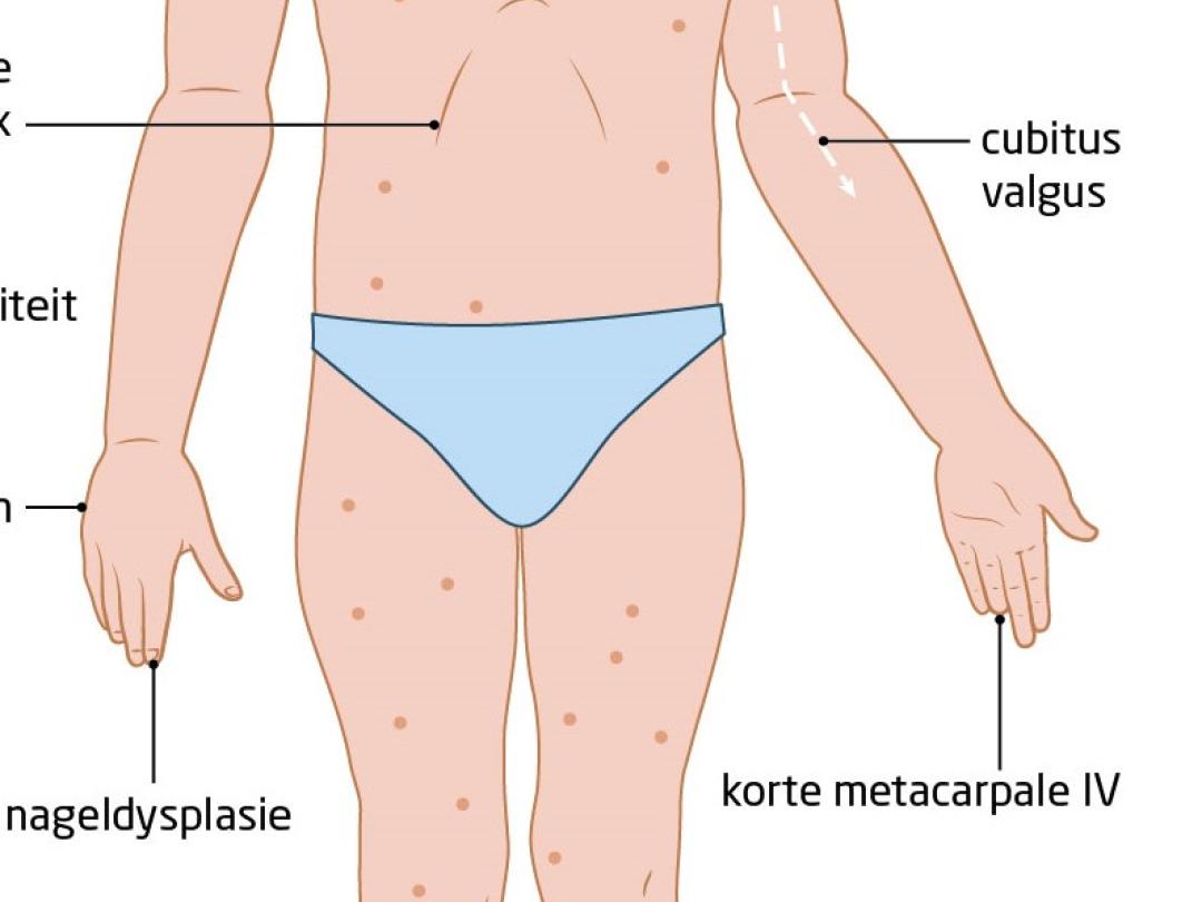 uitingsvormen van Turner-syndroom