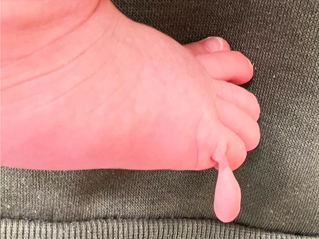 Extra teentje van patiënt B