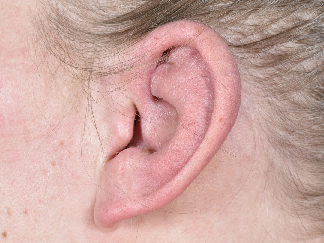 Een gezwollen oor