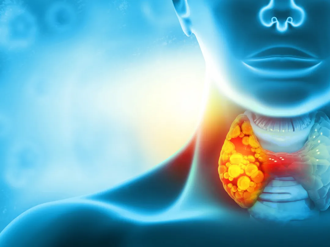 Thyroid