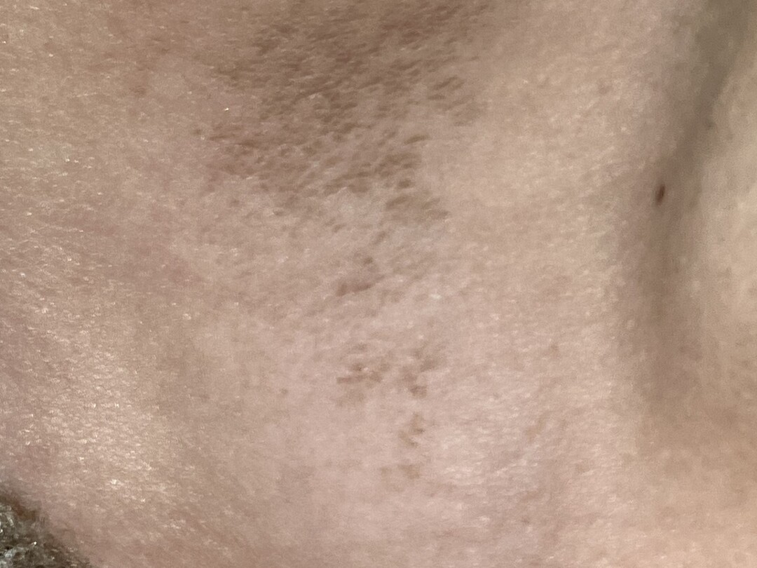 Verkleuring in de hals