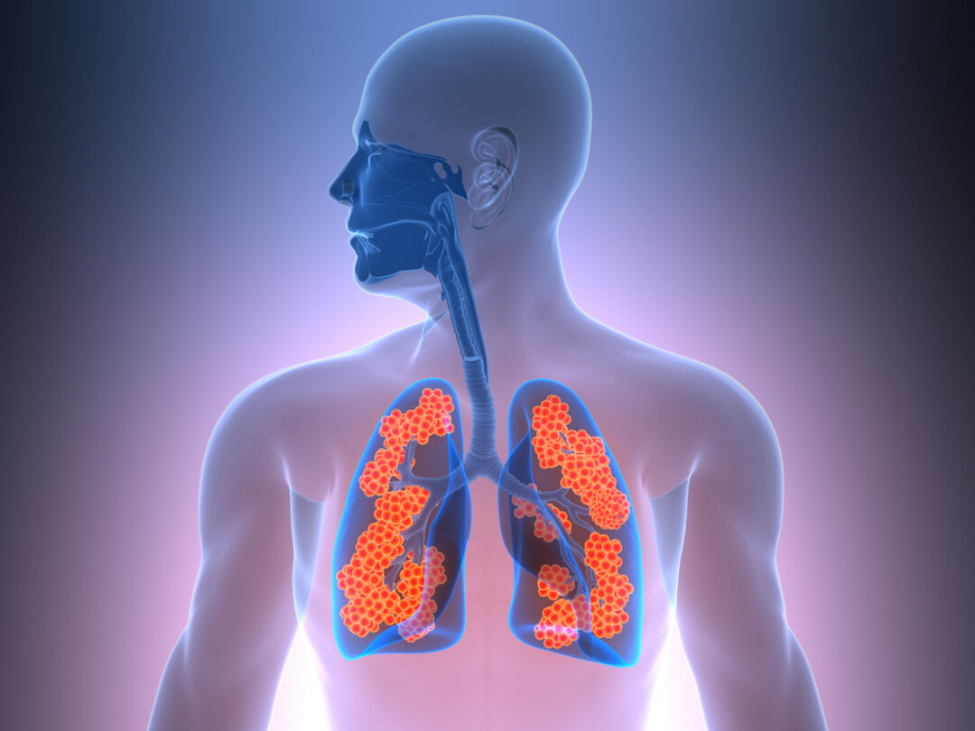Illustratie van longen met een aandoening