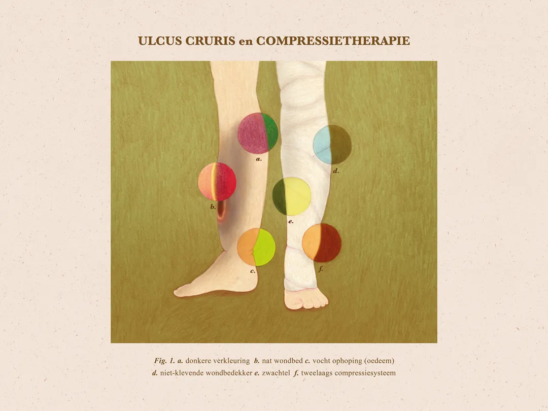 Illustratie van ulcus cruris