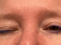 Foto van een patiënt waarbij een ptosis van het rechter oog zichtbaar is.