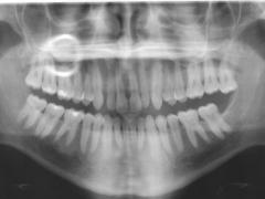 Tandheelkundige röntgenfoto vergroot risico schildklierkanker