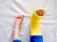 Een paar voeten waarvan de rechter voet in het gips zit.