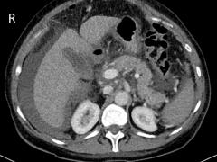 Axiale CT-scan van de bovenbuik in de portaal-veneuze fase.