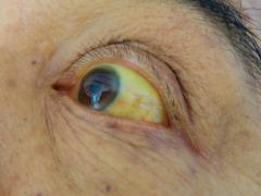 Een persoon met geelzucht.