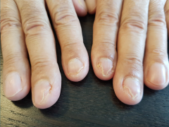 Brokkelige vingernagels.