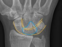 Röntgenfoto van de pols.