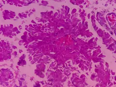 hersencarcinoom