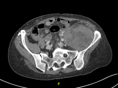 CT-angiogram van het abdomen.